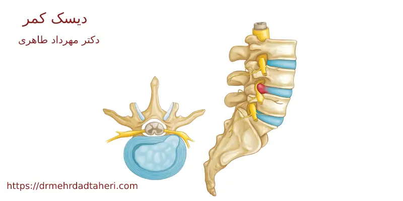 علت دیسک کمر