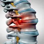 تشخیص فتق دیسک کمر