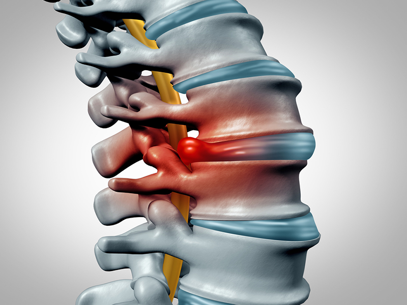 تشخیص فتق دیسک کمر