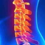 درمان دیسک گردن با دارو