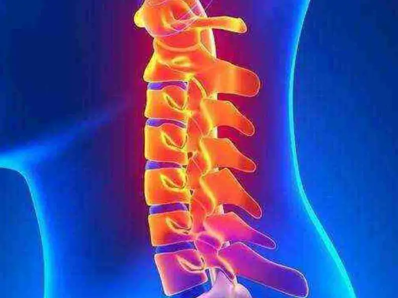 درمان دیسک گردن با دارو