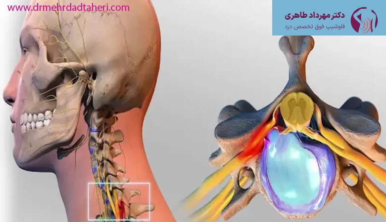 درمان دیسک گردن با چه روش‌هایی انجام می‌شود؟
