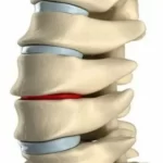 علائم دیسک کمر خطرناک