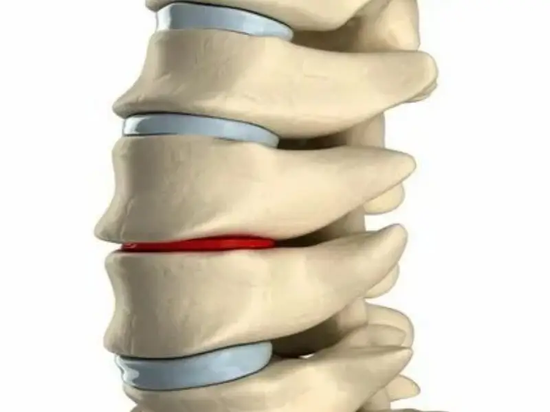 علائم دیسک کمر خطرناک