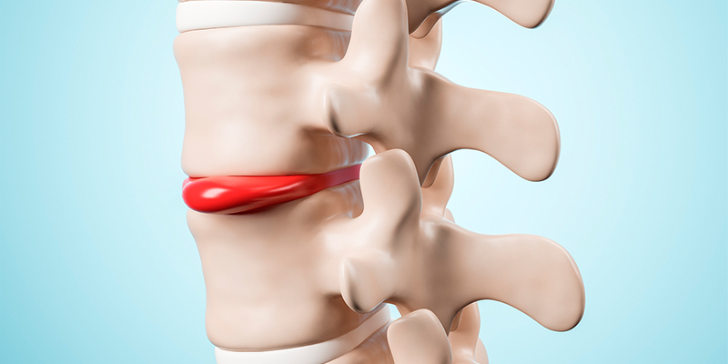 علائم دیسک کمر خفیف