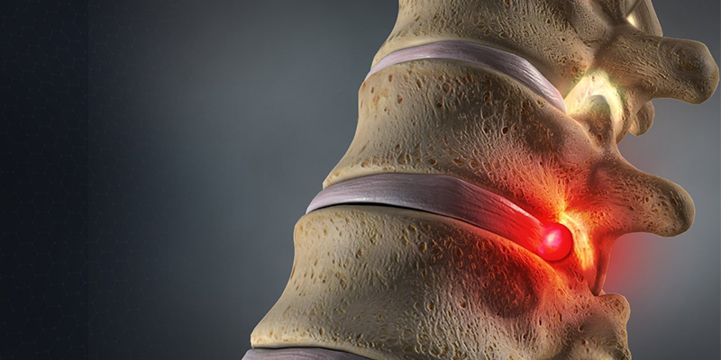 علائم فتق دیسک کمر