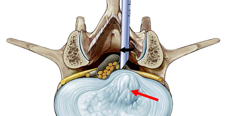 علل فتق دیسک کمر