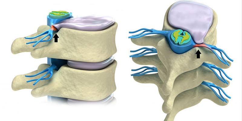 فتق دیسک کمر