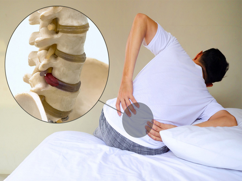 نحوه استراحت برای درمان دیسک کمر