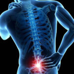 پارگی دیسک کمر