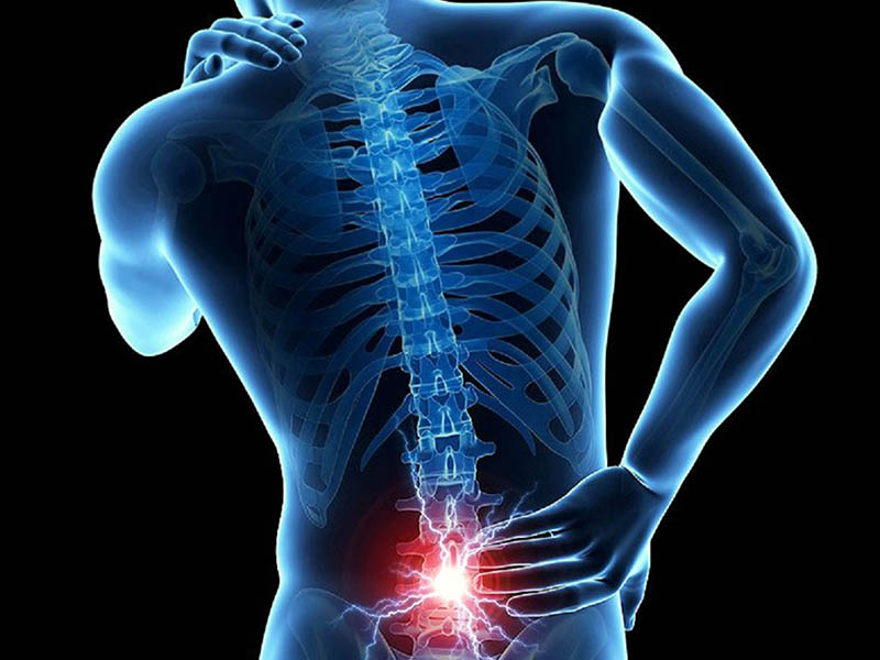 پارگی دیسک کمر