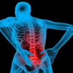 درمان درد سیاتیک با لیزر برای چه افرادی مناسب است؟