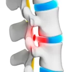 کم آبی دیسک کمر