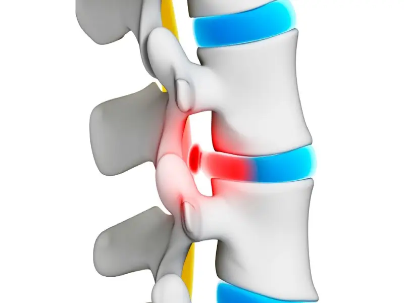 کم آبی دیسک کمر