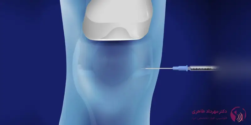 آیا استفاده از سلول_های بنیادی در درمان زانو در همه مراحل آرتروز مفید است؟