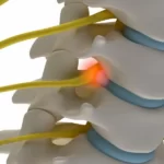 بهترین جراح دیسک کمر با لیزر در تهران