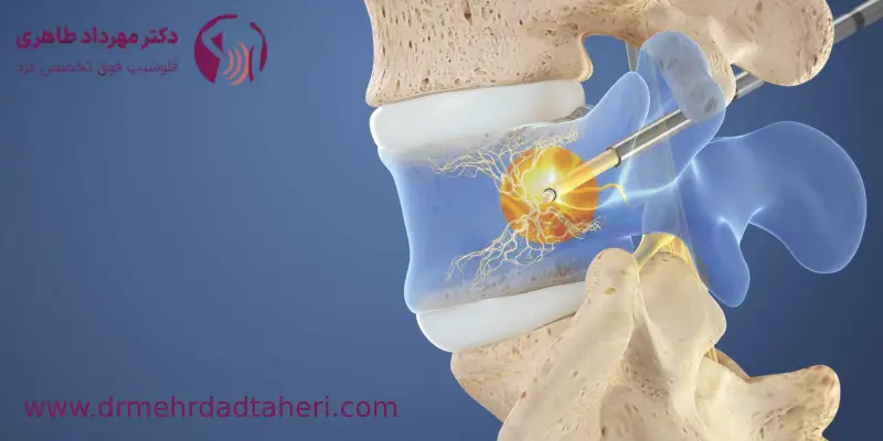 جراحی دیسک گردن با لیزر