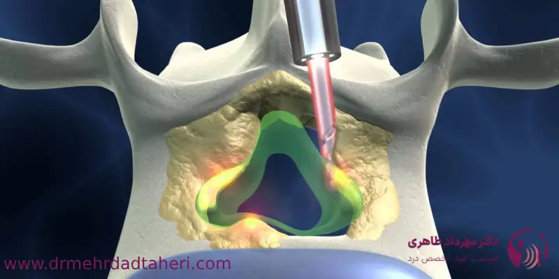 درمان تنگی کانال نخاعی با ليزر چه کاربردی دارد؟