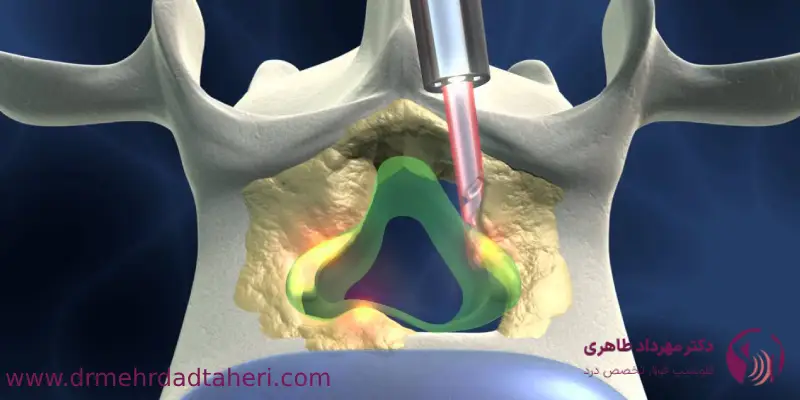 درمان تنگی کانال نخاعی با لیزر چیست و چگونه انجام می_شود؟