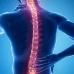 ورزش بعد از عمل لیزر دیسک