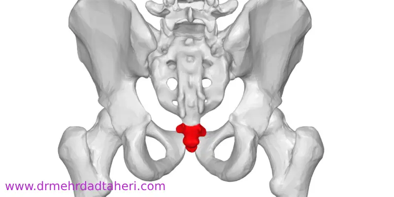 بلوک عصبی برای درمان درد دنبالچه