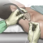 تزریق بلوک عصبی چیست؟