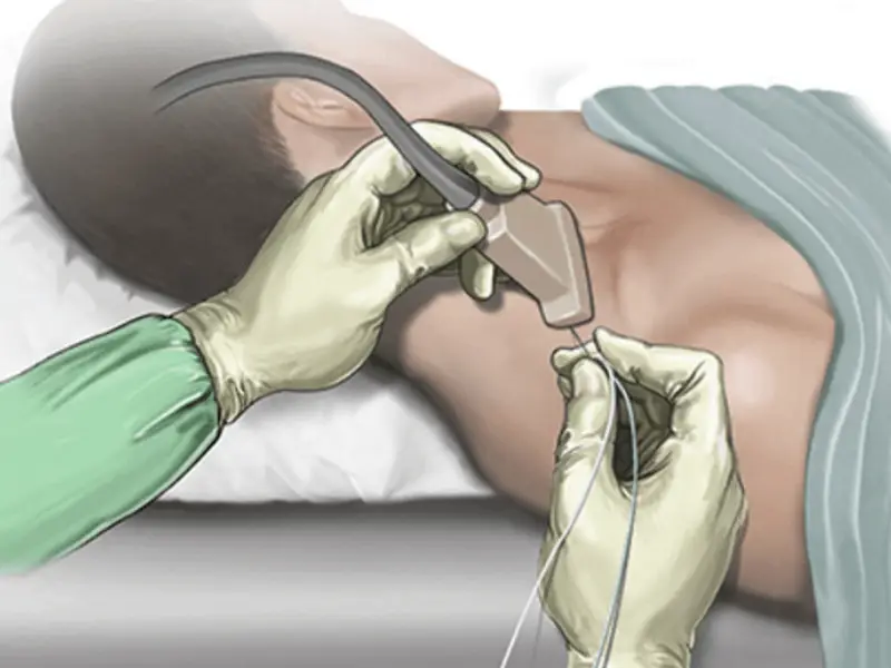 تزریق بلوک عصبی چیست؟