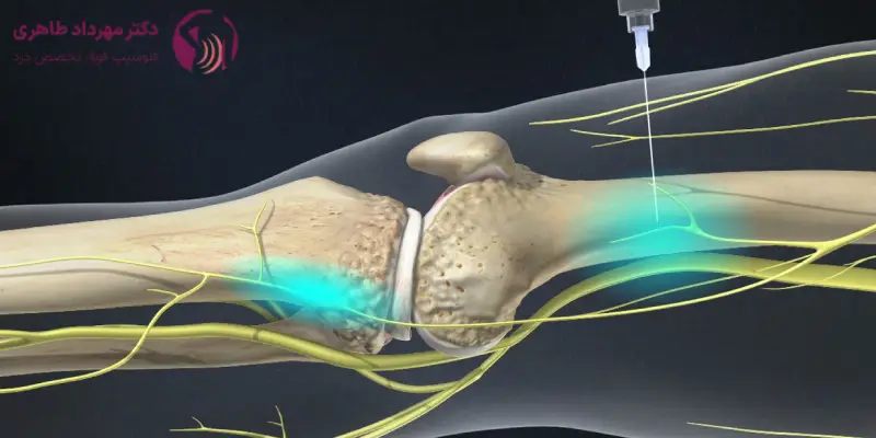 تزریق بلوک عصبی