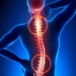 درمان دیسک کمر با استفاده از سلول بنیادی