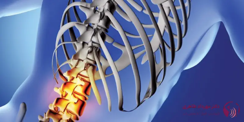 درمان دیسک کمر با سلول های بنیادی