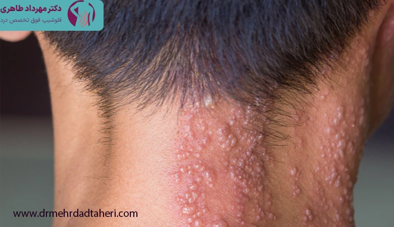 علت بروز بیماری زونا