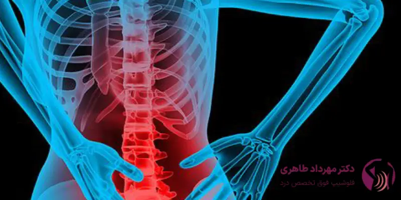 اثرات اوزون_تراپی برای دیسک کمر