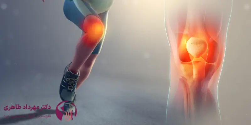 انواع زانو درد + علت