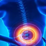 اوزون_تراپی دیسک کمر چیست و چه کاربردی دارد؟