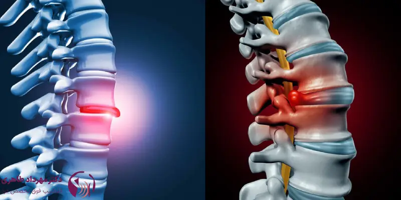 مراقبت_های بعد از اوزون_تراپی دیسک کمر