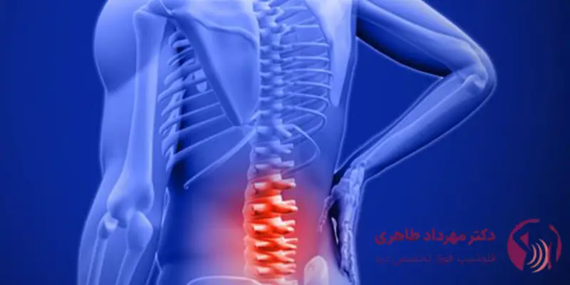 مزیت_های اوزون_تراپی دیسک کمر