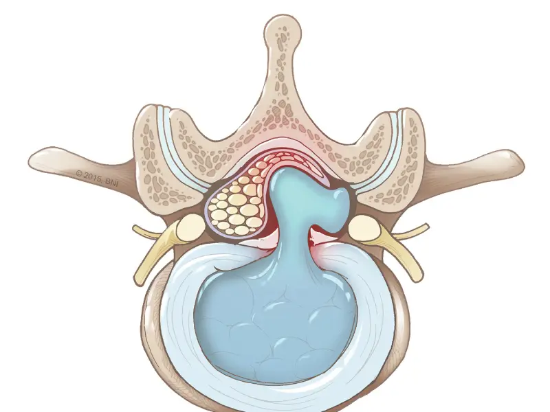 آیا لیزر درمانی برای فتق دیسک موثر است؟