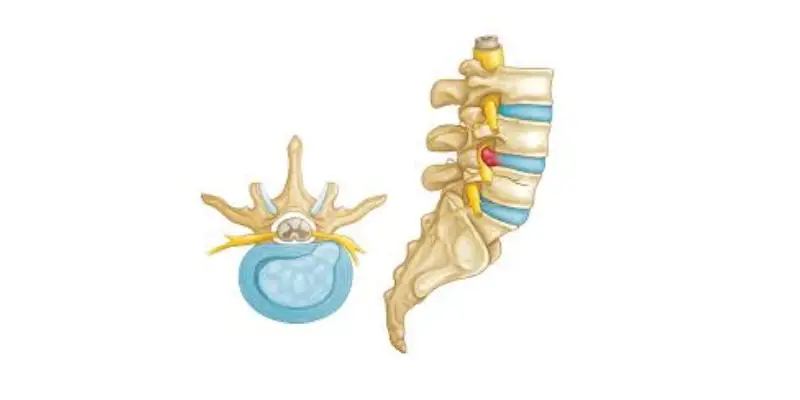 آیا لیزر درمانی برای فتق دیسک موثر است؟