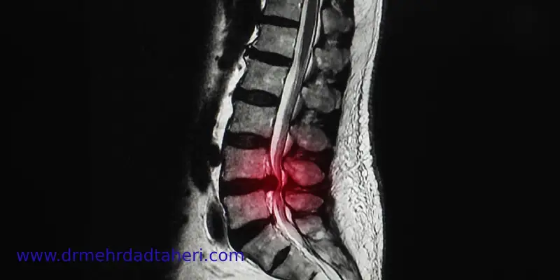 اثربخشی و طول عمر تسکین تزریق اپیدورال تنگی کانال نخاعی