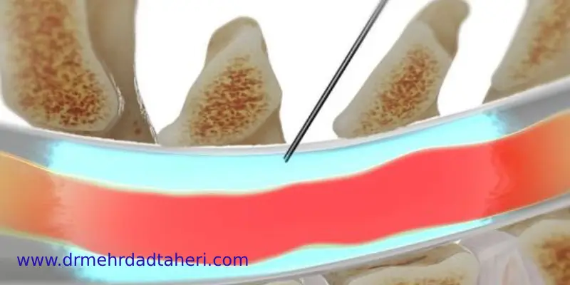 تزریق اپیدورال برای تنگی کانال نخاعی