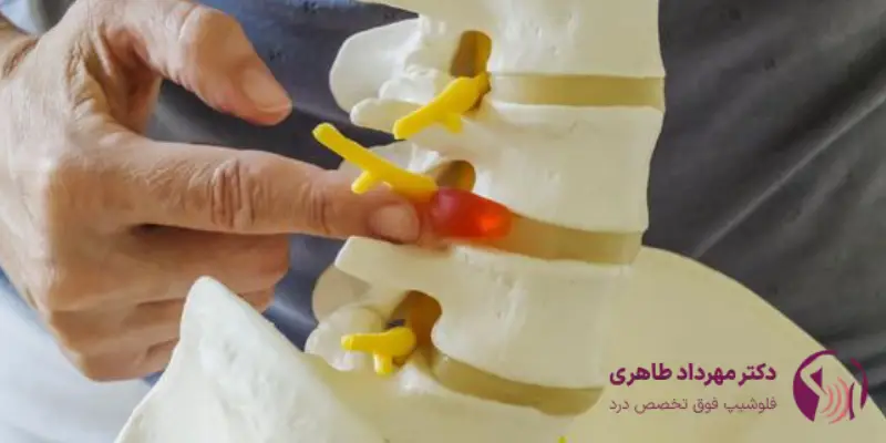 تزریق اپیدورال برای سیاتیک