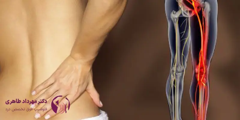 تزریق اپیدورال برای سیاتیک:گزینه درمانی موثر برای تسکین درد