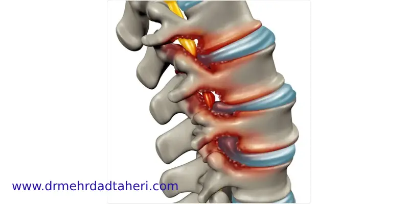  نقش و فواید تزریق اپیدورال برای تنگی کانال نخاعی