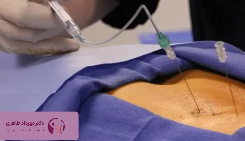 کاربردهای تزریق اپیدورال