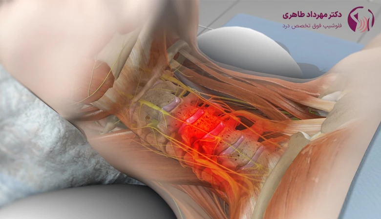 مزیت‌های جراحی دیسک گردن با لیزر