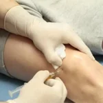 هزینه پی آر پی زانو