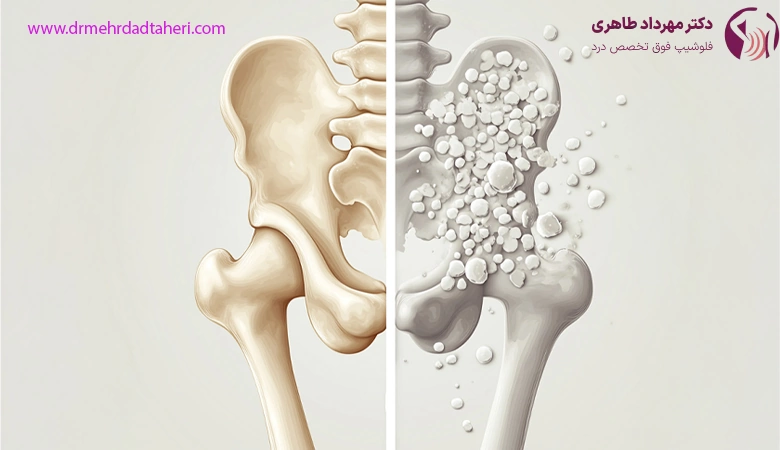تشخیص پوکی استخوان