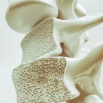 پوکی استخوان را شکست دهید