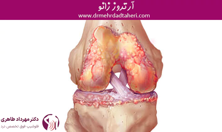 آرتروز زانو