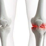 علائم آرتروز زانو